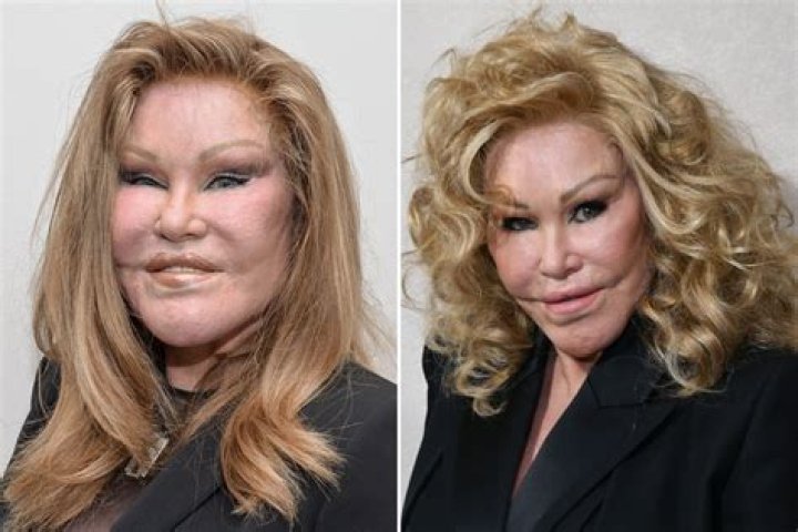 Cat Woman (Jocelyn Wildenstein) Plastic Surgery Before And AFter
