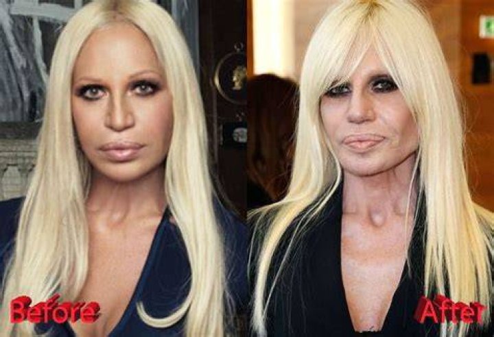 Donatella Versace Before Plastic Surgery Under All the Makeup, Botox