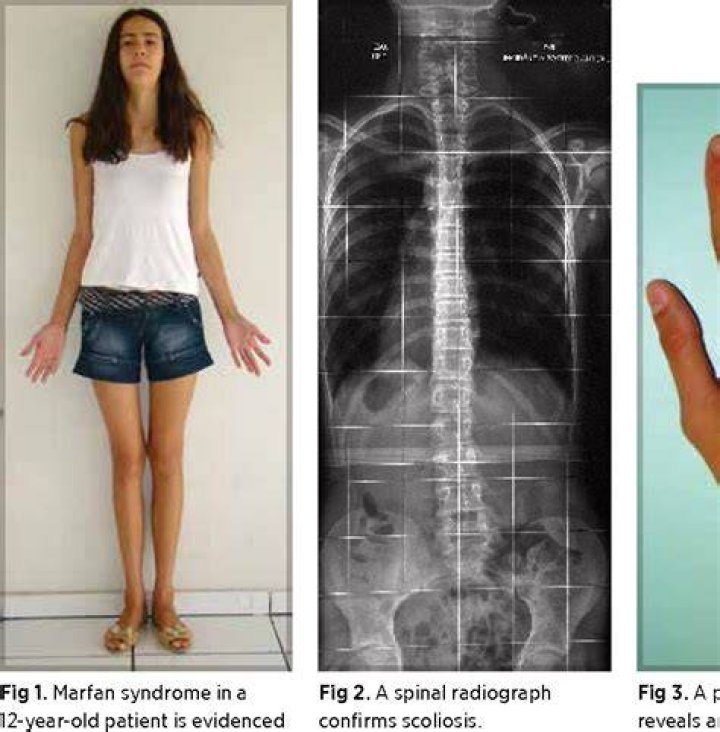 Figure 3 from Marfan syndrome report of two cases with review of
