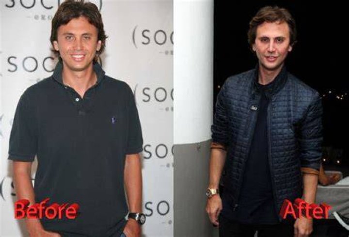 Jonathan Cheban Plastic Surgery You Be The Judge