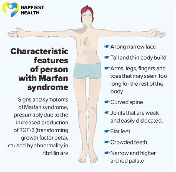 Marfan syndrome Cause and Diagnosis Happiest Health