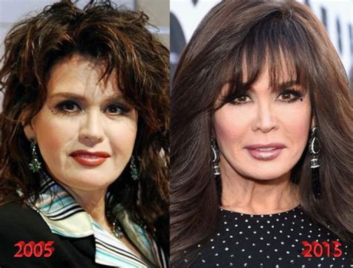 Marie Osmond Plastic surgery Before and After Photo 20132014