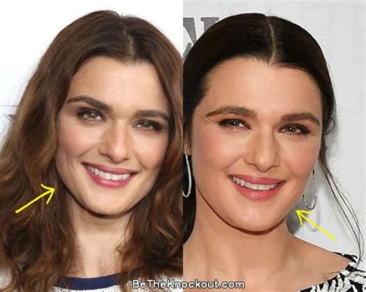 Rachel Weisz Facelift Plastic Surgery Before and After Celebie